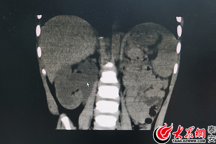 3个5毫米 两岁重度肾积水幼童恢复健康--泰医附