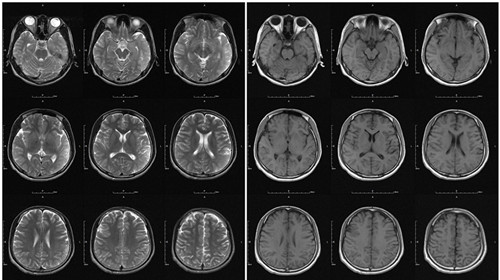 MRI检查下的癫痫发作 可测乳酸癫痫区域的变化