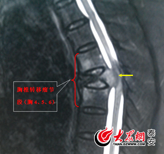 泰安市中心医院成功开展胸椎转移性肿瘤全脊椎整块切除脊柱功能重建术