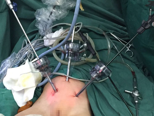 手术通过腹部的3个5mm的trocar,置入腹腔镜器械进行操作,避免了膀胱