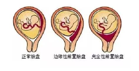 凶险型前置胎盘的管理策略