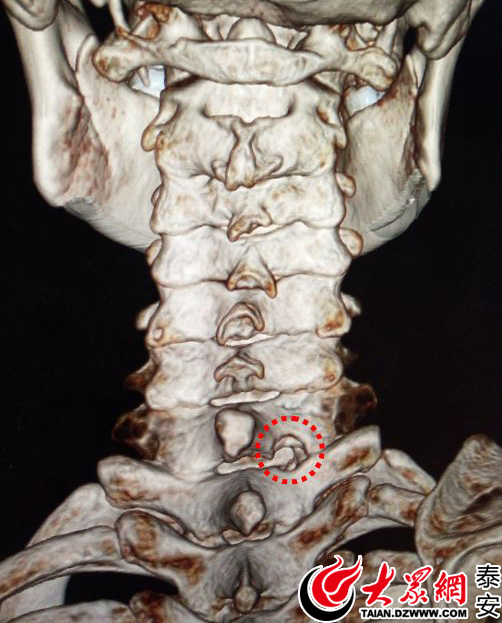 颈椎横突图片图片