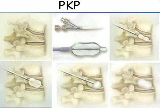 pkp手术进针点图解图片