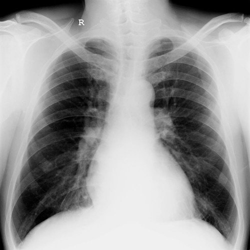 肺水肿的x线表现图片图片