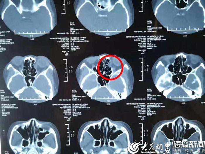 内眦韧带断裂图片