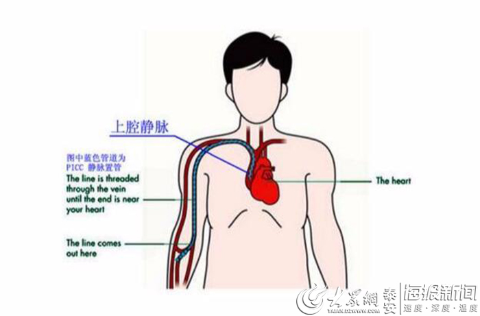 泰安市中医医院外二科护理团队完成首例在彩超引导下中心静脉置管术